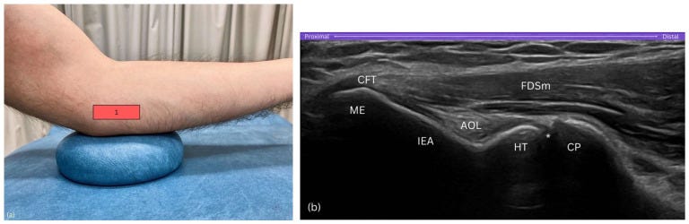 Tendon distal biceps 3 2 Tempo Formacion Ecografia.jpg
